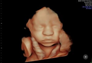 El mejor momento para la ecografía 5D